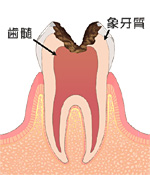 中後期段階　～根管治療を行います～