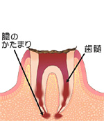 後期（末期）段階　～抜歯せざるを得ません～