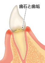 2.歯肉炎（しにくえん）