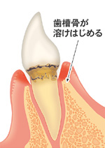 3.軽度・歯周炎（ししゅうえん）