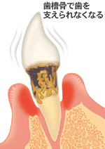 5.重度・歯周病（ししゅうえん）